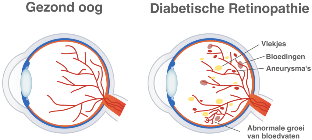 Diabetes retinopathie