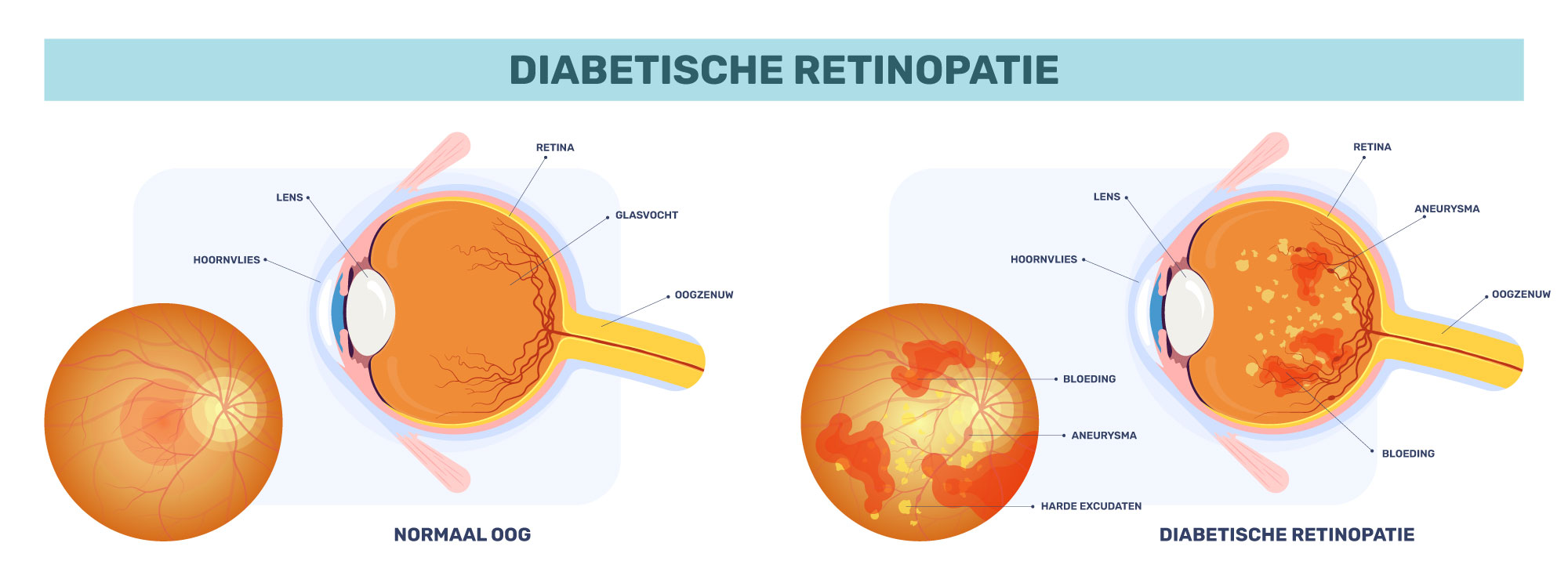 diabetische retinopatie